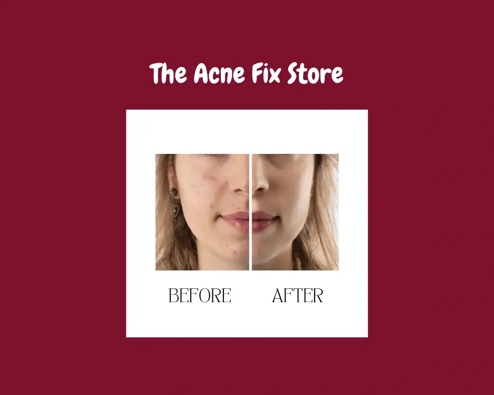 The Acne Fix Store - A Korean skincare routine to clear skin.