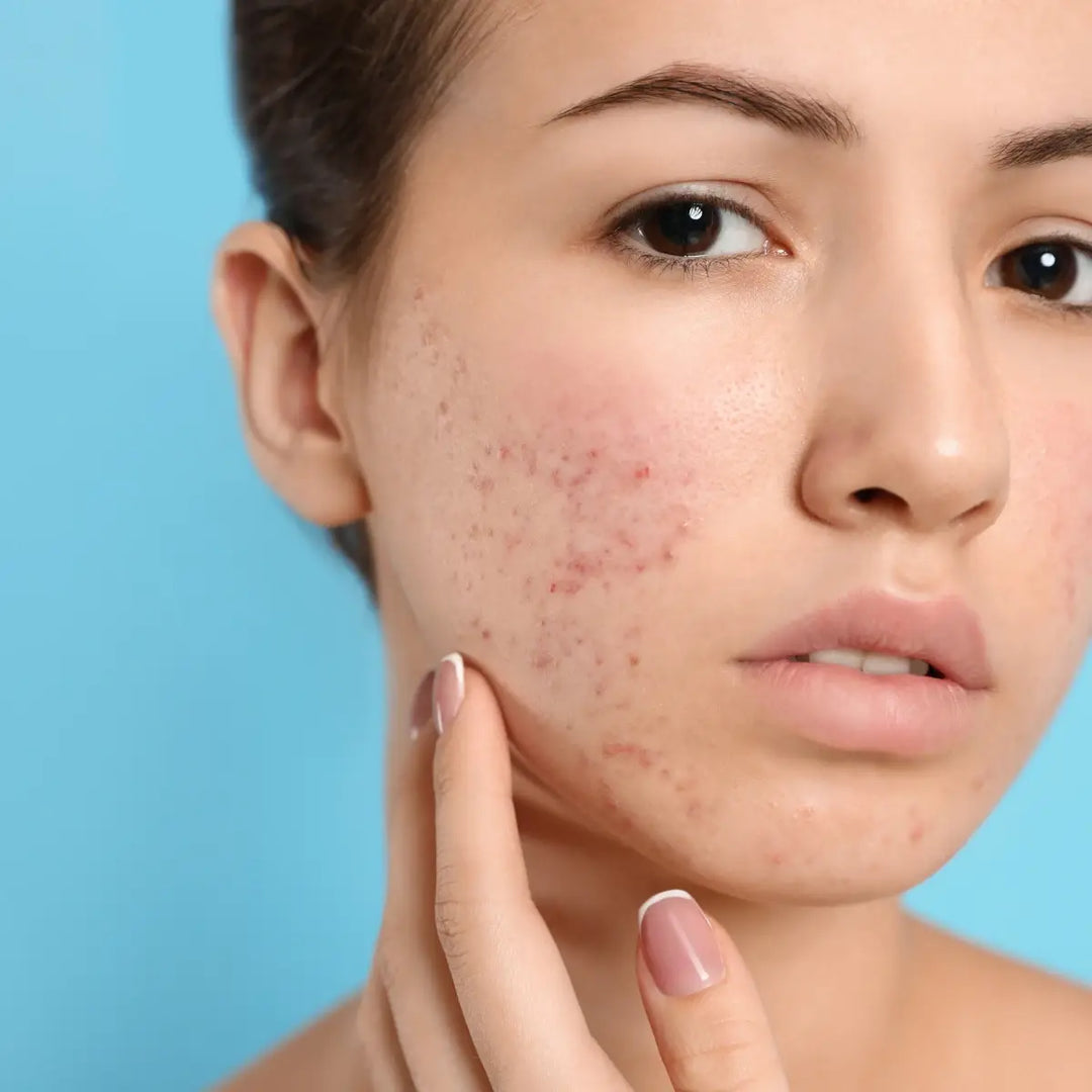 Korean skincare products for treating acne scars and pigmentation in UAE