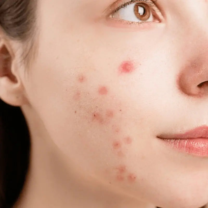 Best Korean Skincare for Acne & Blemishes in UAE – Clear Breakouts Fast
