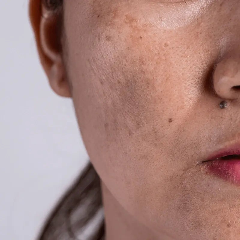 Best Korean Dark Spot Correctors in UAE – Fade Pigmentation & Acne Marks