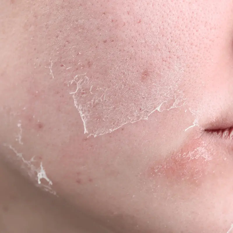 Eczema and dryness relief Korean skincare for itchy dry sensitive skin in UAE