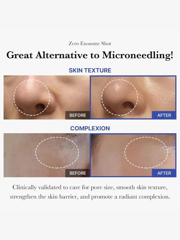 medicube – One Day Exosome Shot Pore Ampoule 7500 [30ml] - before and after