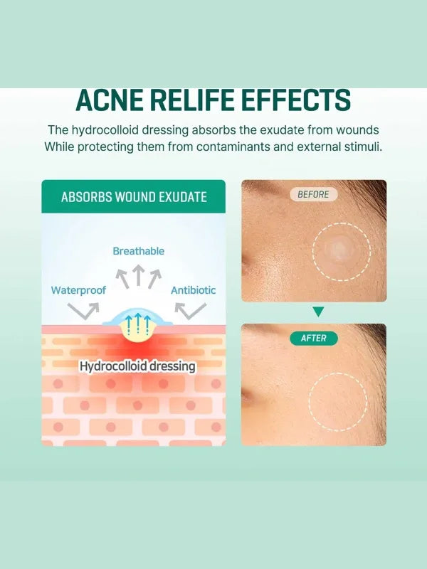 Before and after using SOME BY MI Clear Spot Patch – visibly reduced pimples, redness and inflammation overnight